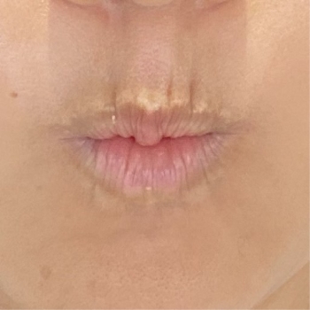 唇の上の縦皺