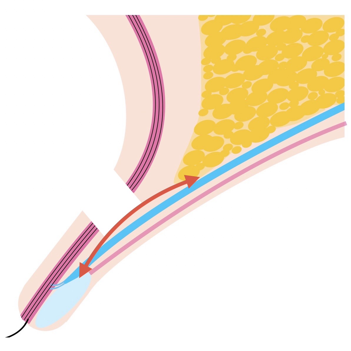 眼瞼下垂症手術