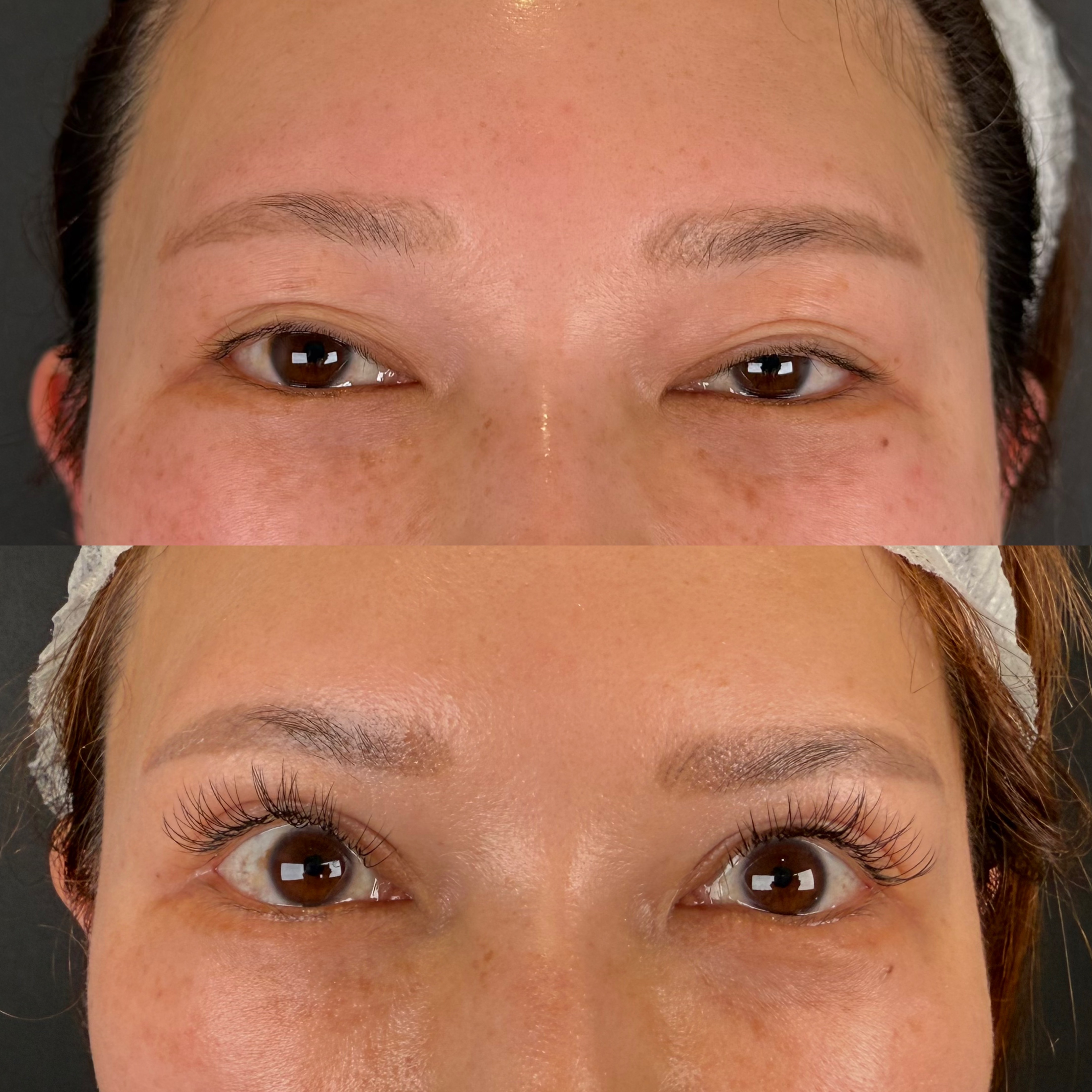 眼瞼下垂症手術