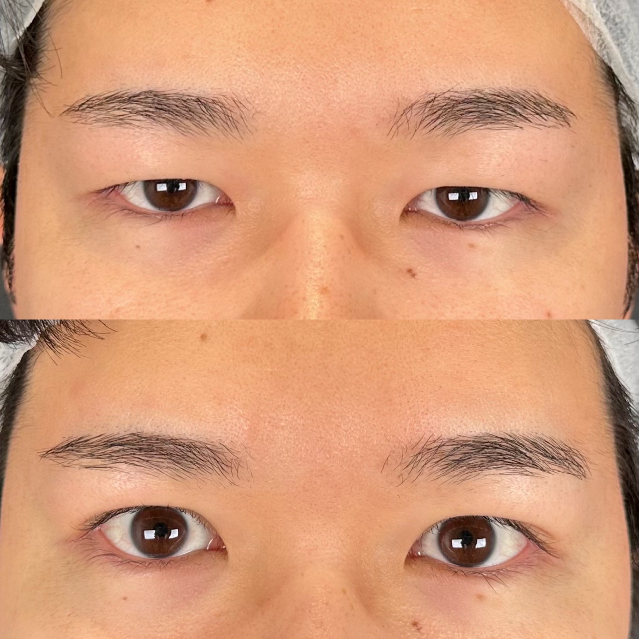 眼瞼下垂症手術