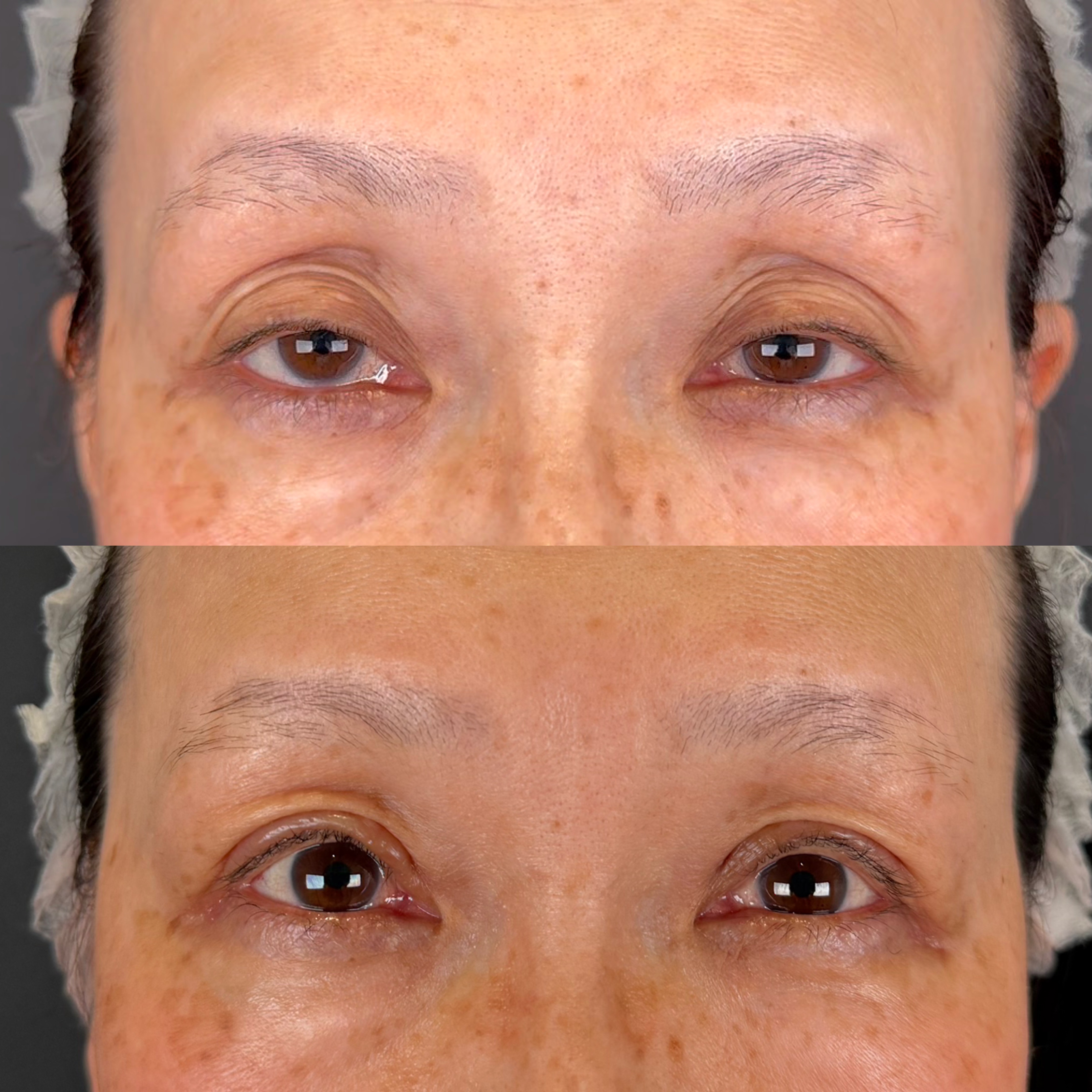 眼瞼下垂症手術