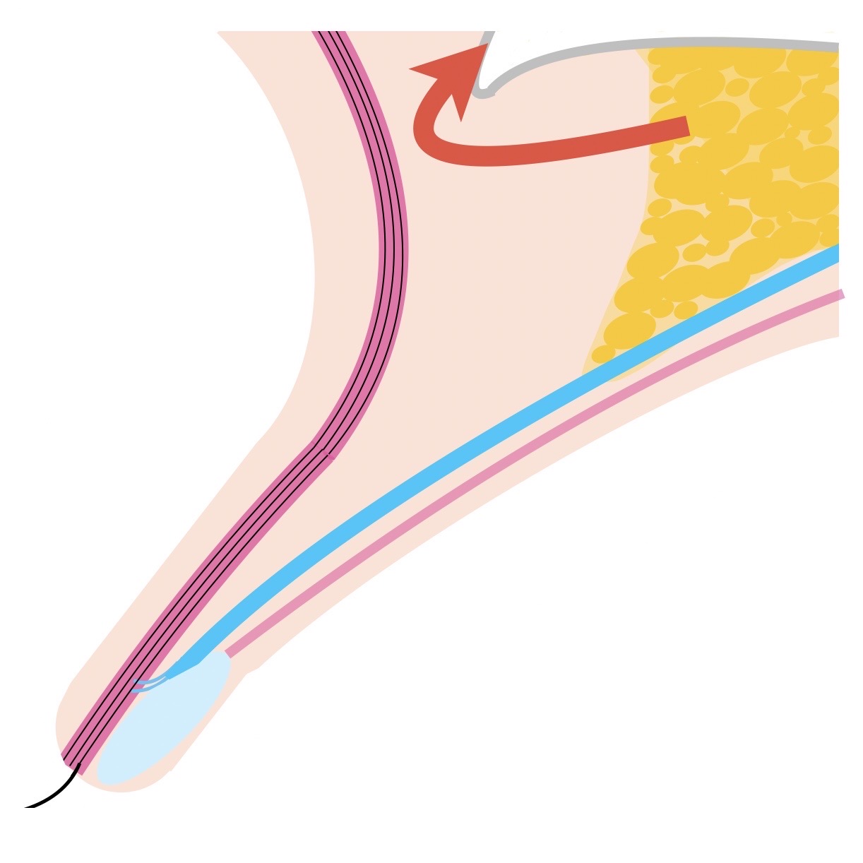 眼瞼下垂症手術