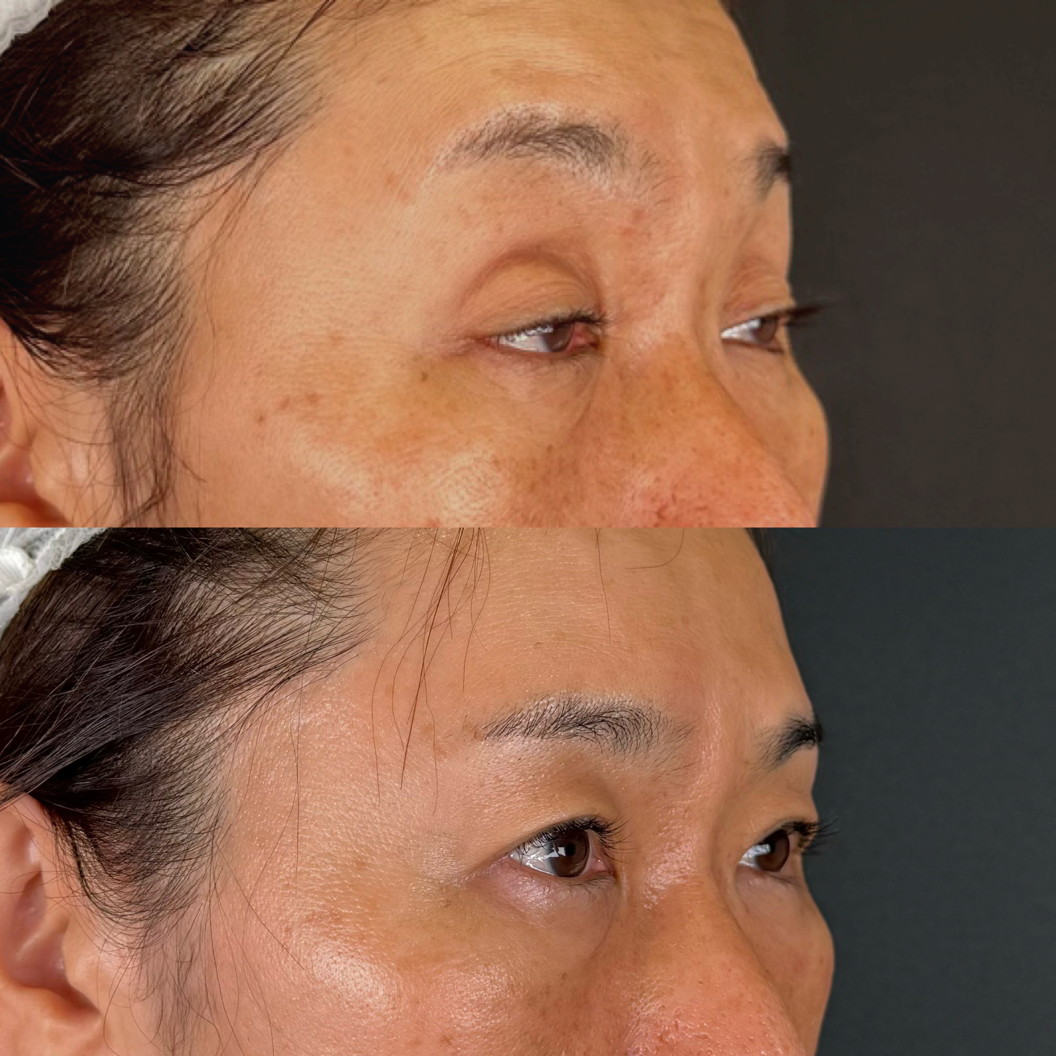 眼瞼下垂症手術