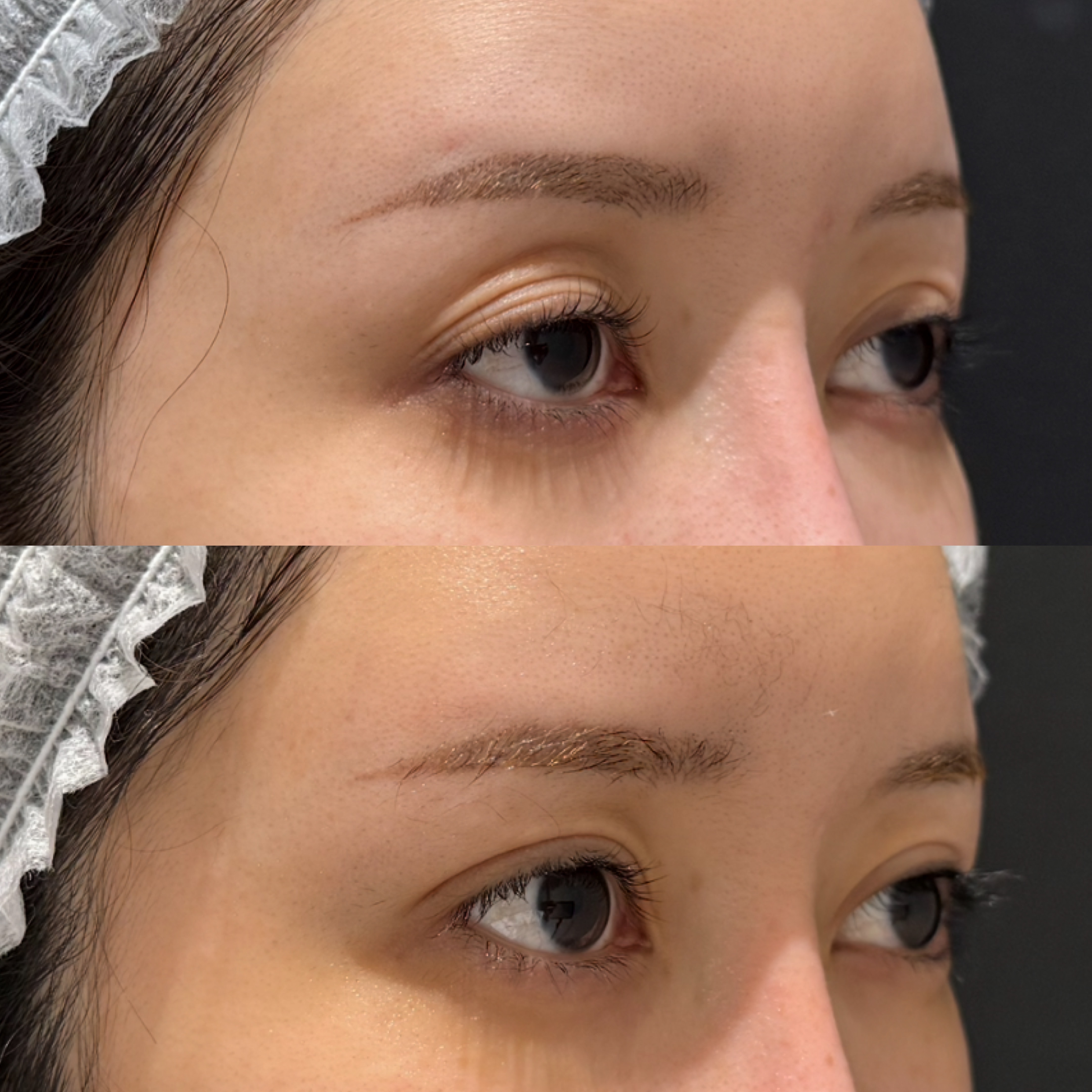 眼瞼下垂症手術