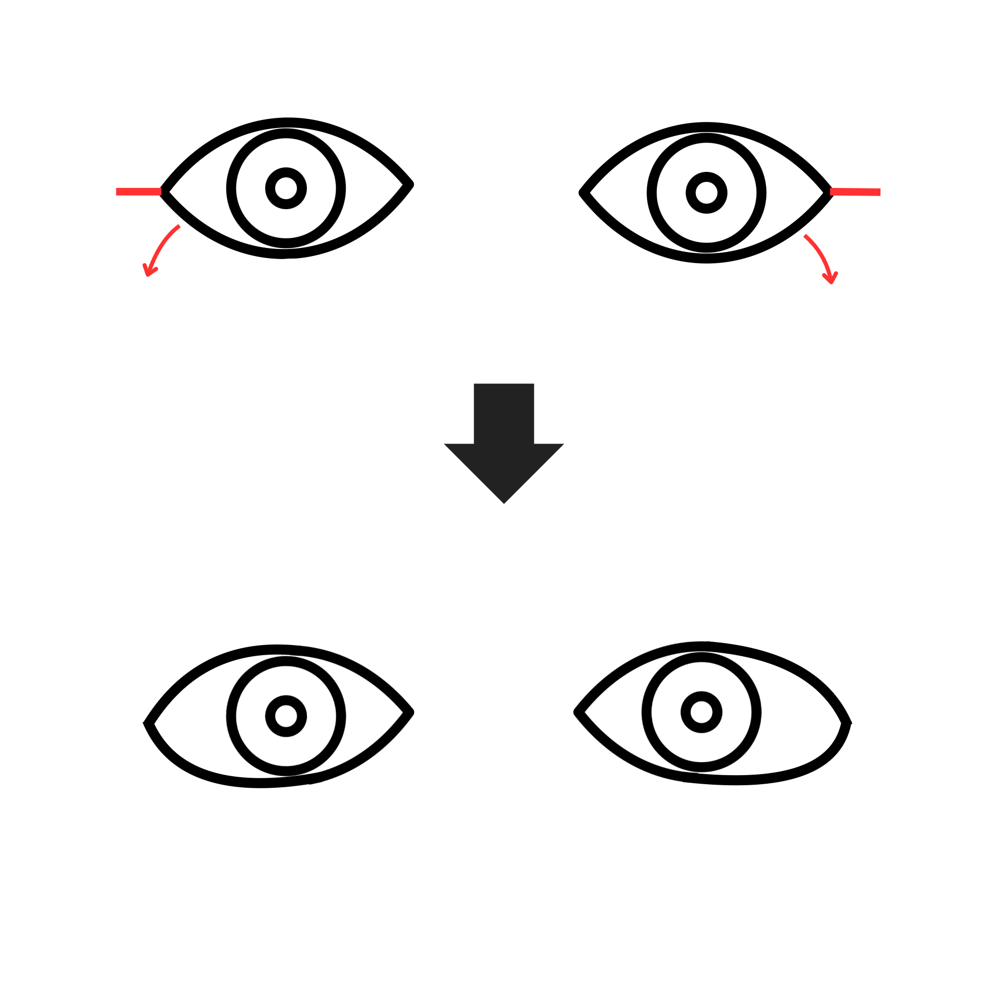 目尻切開・タレ目術