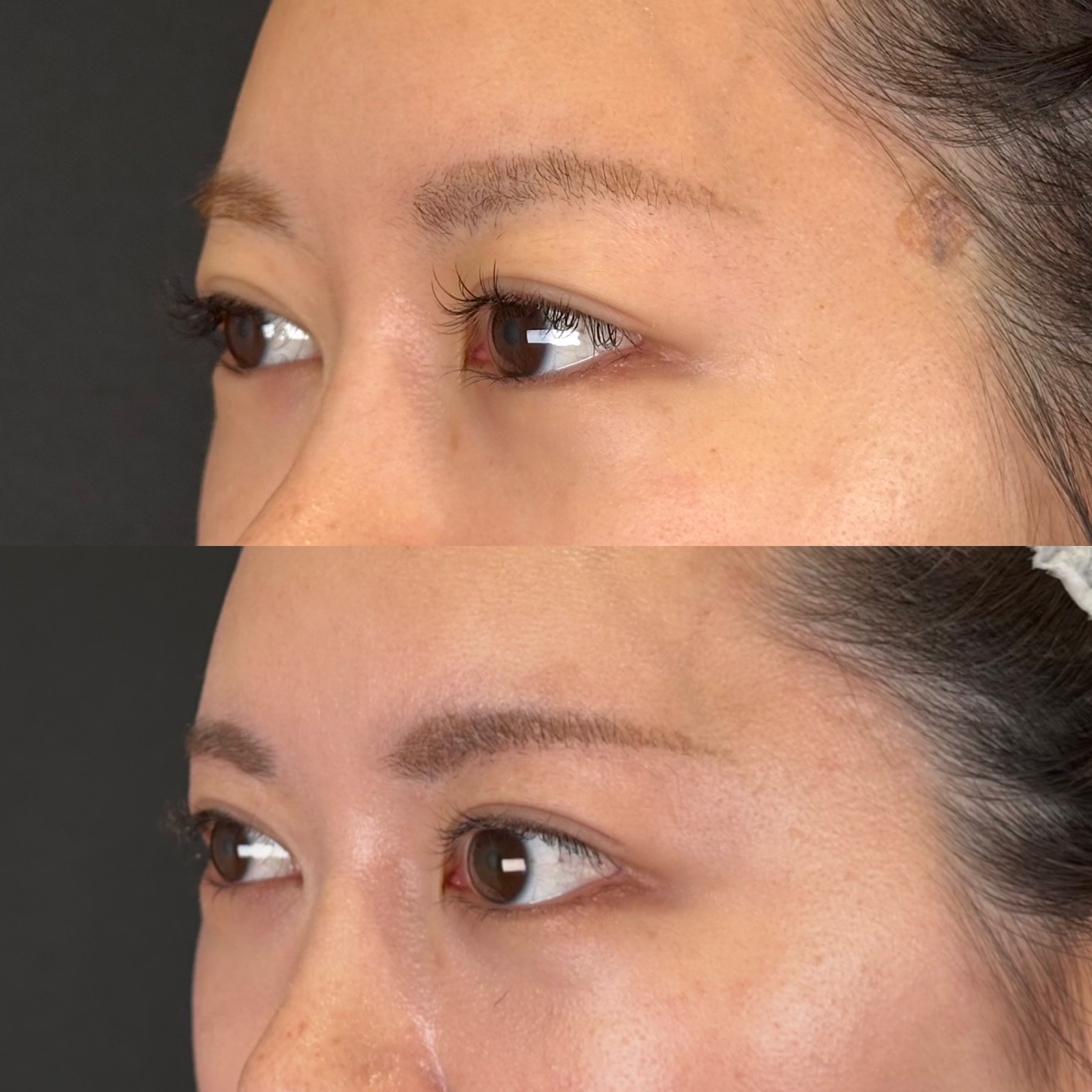 目尻切開・タレ目術