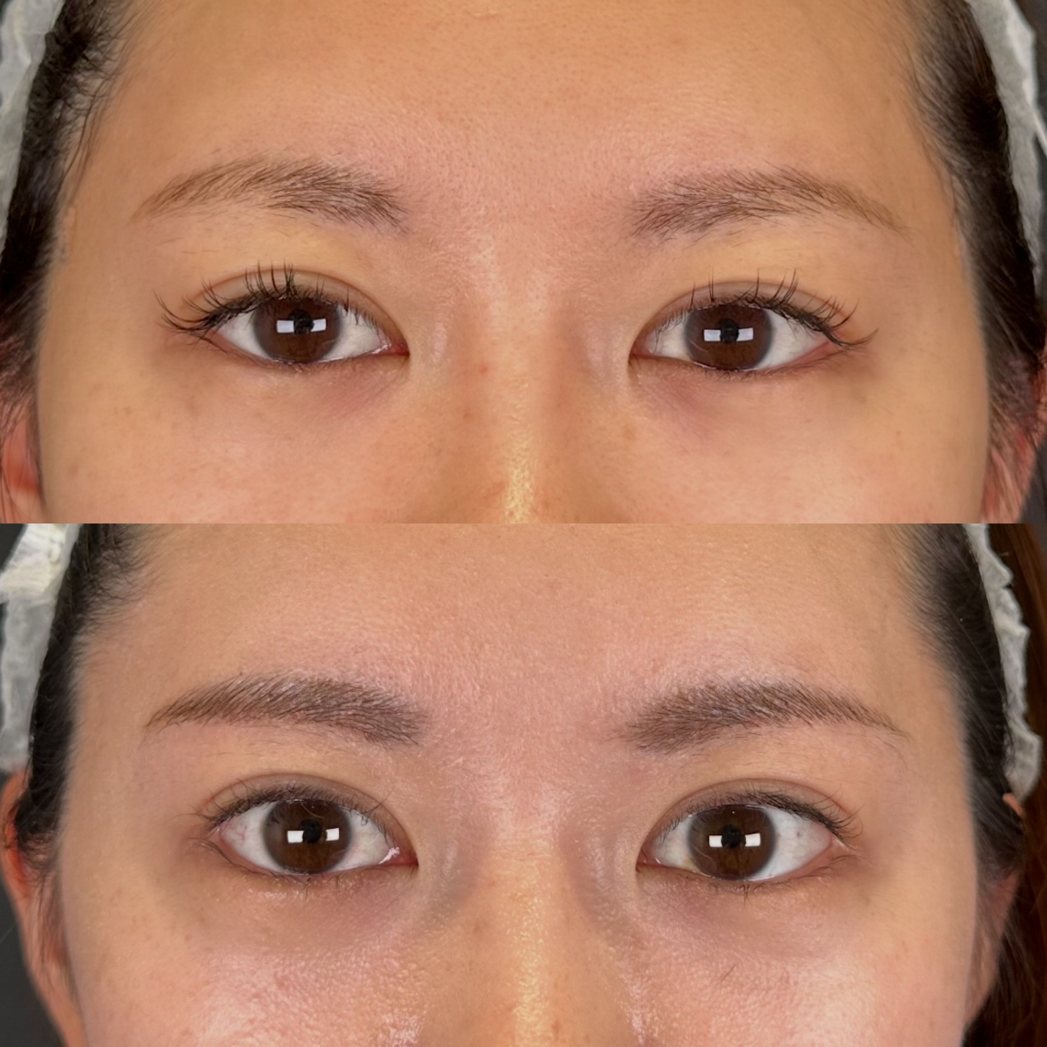 目尻切開・タレ目術